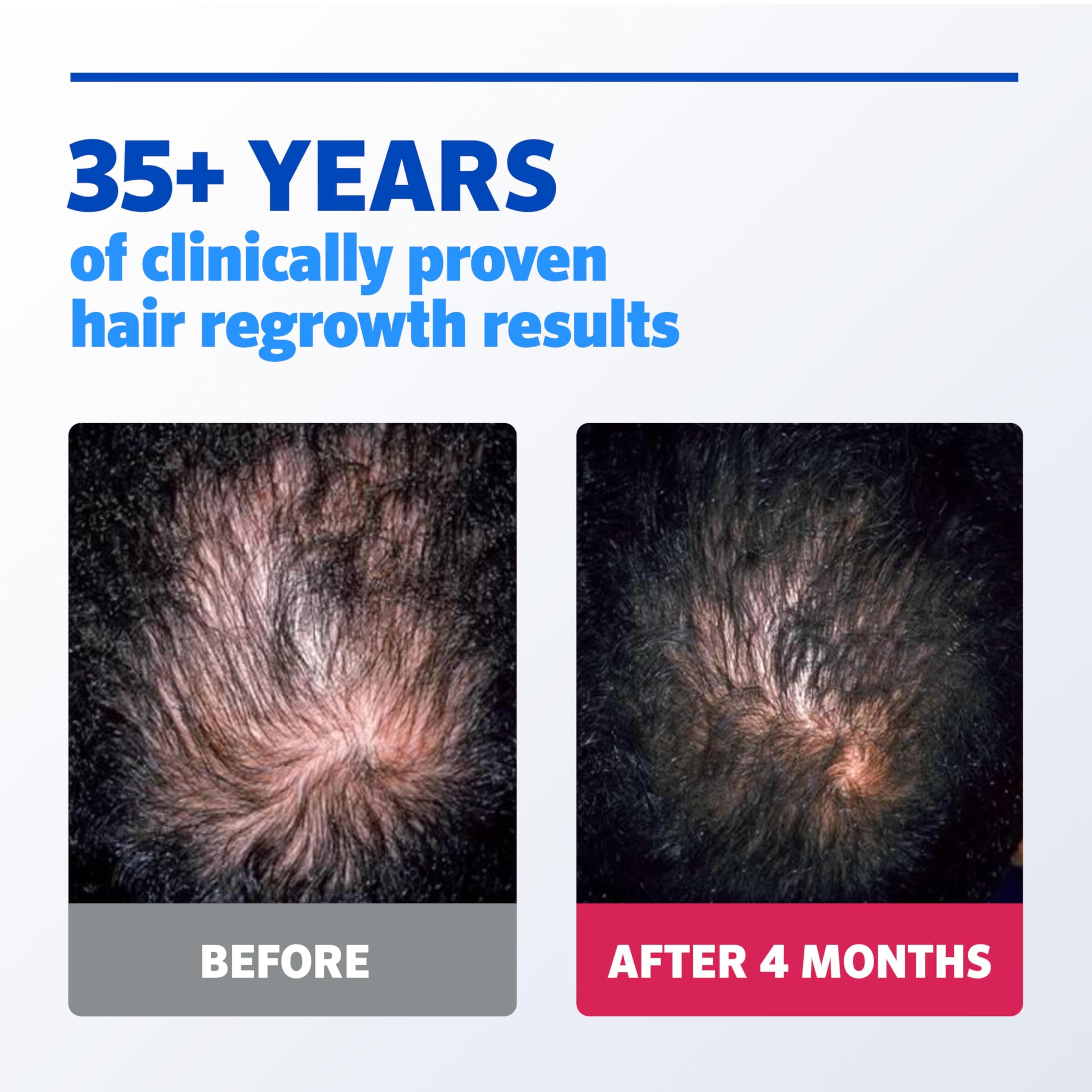 Men’s Rogaine Extra Strength 5% Minoxidil, Topical Solution for Thinning & Hair Loss, Clinically Proven FDA Approved Minoxidil for Men Treatment, Regrow Fuller Hair, 3 Month Supply, 3 Bottles - Image 5